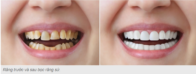 Nhiều người gặp vấn đề về răng miệng như răng sứt mẻ, mòn, nhiễm màu,... ảnh hưởng đến thẩm mỹ và chức năng ăn nhai. Bọc răng sứ là giải pháp phổ biến giúp phục hồi răng, cải thiện nụ cười và nâng cao chất lượng cuộc sống. Bọc răng sứ không cần mài là chủ đề thu hút nhiều sự quan tâm trong thời gian gần đây. Bài viết này sẽ cung cấp thông tin chi tiết về vấn đề này, đồng thời chia sẻ những lời khuyên hữu ích từ các bác sĩ nha khoa uy tín trên cộng đồng Hỏi đáp nha khoa Tdentist.